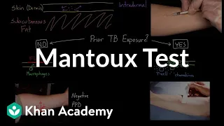 Mantoux test (aka. PPD or TST) | Infectious diseases | NCLEX-RN | Khan Academy