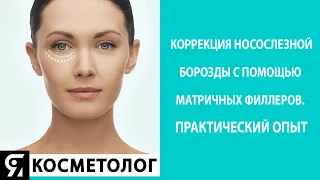 Коррекция носослезной борозды с помощью матричных филлеров  Практический опыт