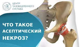 🦵 Что такое асептический некроз головки бедренной кости? Асептический некроз головки бедра. 18+