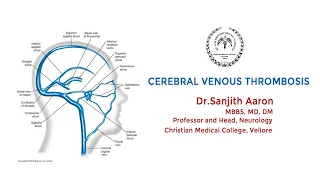 Cerebral Venous Thrombosis - CVT - Dr.Sanjith Aaron, CMC Vellore