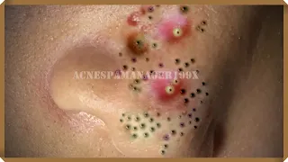 Extreme Blackhead Removal at LNG Skin Care #016