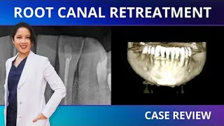 Analyzing a Root Canal Retreatment with CBCT: Case Review