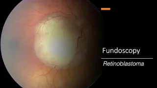 Retinoblastoma: Fundoscopy