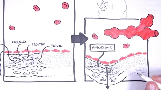 Polyarteritis Nodosa and Kawasaki Disease (Medium Vessel Vasculitis) - Symptoms, pathophysiology