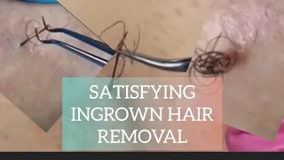 SATISFYING  INGROWN HAIR REMOVAL