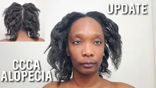 CCCA Alopecia Hair Care | Hair & Scalp Update #alopecia