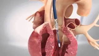 TAVI transfemoral - Transcatheter Aortic Heart Valve - 3D Animation Medizin