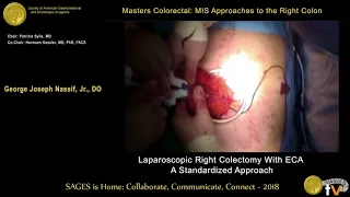 Laparoscopic right colectomy with extracorporeal anastomosis-standard approach