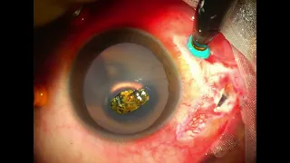 Metallic Chip Foreign Body inside the Eye