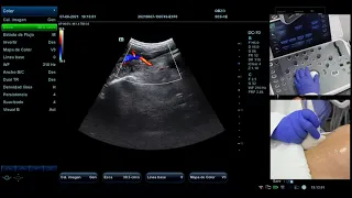 ¿Cómo realizar la medición de la Arteria Uterina con Ecografía Doppler?