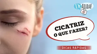 O QUE FAZER PARA DEIXAR CICATRIZ MENOS APARENTE?