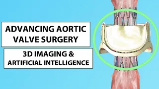 Patient Webinar: Advances in Aortic Valve Surgery with 3D Imaging & Artificial Intelligence