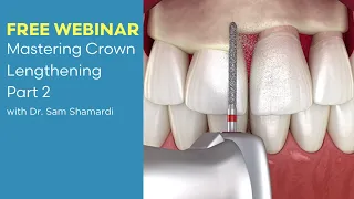 Dental Treatment: Esthetic Crown Lengthening Sep 1, 2021