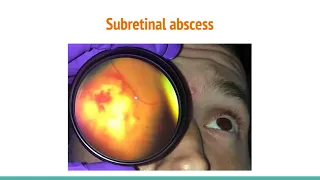 Case Reports: Subretinal Abscess