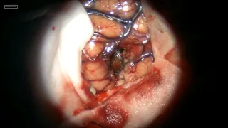 Occipital lobe abscess #brainabscess #Abscess #AmerBadran