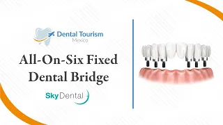 All on Six Fixed Bridge (Full Mouth Dental Implants) Mexico City - Dental Tourism Mexico