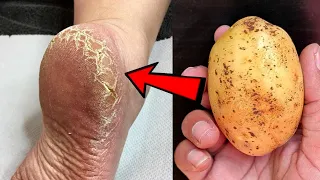 Eliminate Cracked Heels and get White and Smooth Feet / Magic Cracked Heels home remedy