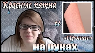 Красные пятна и "прыщи" на руках? / Куриная кожа (chicken skin)