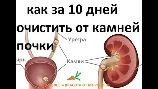 как за 10 дней очистить от камней почки