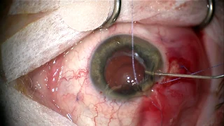 Anterior chamber washout, pars plana vitrectomy, and Ahmed glaucoma implant using vitrectomy port