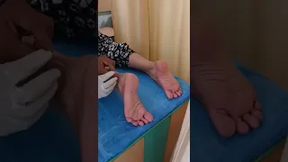 👠 Heel pain Treatment By Dry Needling