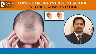 Best Hairline ever recreated | Hair Transplant lower or higher ?-Dr.Deepak P Devakar|Doctors' Circle