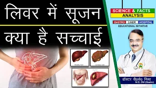 लिवर में सूजन जानिये क्या है पूरी सच्चाई ? || WHAT IS HEPATOMEGALY ?