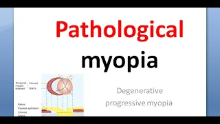 Ophthalmology Pathological myopia crescent Foster Fuchs spot lattice posterior staphyloma atropine