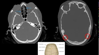 CT Brain -Checklist