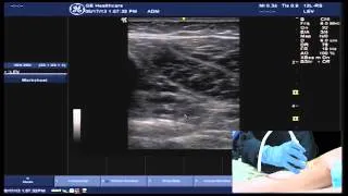 Hot Tips - Locating the Calf Vein with Ultrasound