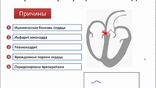 АВ блокады и ее степени на ЭКГ (атривентрикулярные блокады) - meduniver.com