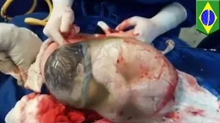 Miracle baby born while still inside amniotic sac