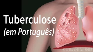 Tuberculose: Infecção Latente e Doença Ativa, Animação. Alila Medical Media Português