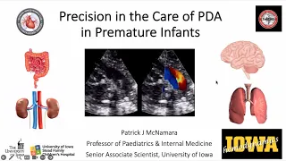 Precision in the Care of Patent Ductus Arteriosus in Premature Infants