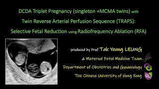 TRAPS in DCDA Triplet pregnancy reduced by RFA