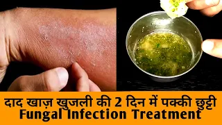 दाद खाज़ खुजली को 2 दिन में जड़ से ख़त्म करेगा Fungal Infection Home Remedy, Daad Khaj Khujli Treatment