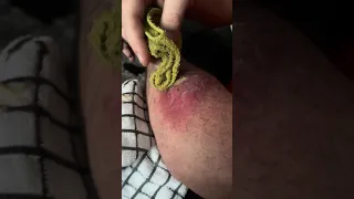 Draining infected spider bite 🕷️