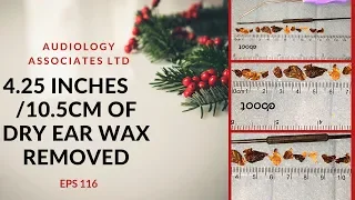 4.25 INCHES/10.5CM OF DRY EAR WAX REMOVED - EP 116