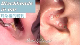 耳朵粉刺 (blackheads in ear)  - Taiwan Tainan台南清粉刺最乾淨