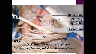 Anatomy of Parasellar region, Cavernous sinus and MCF - EPISODE 3