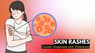 Skin Rash, Causes, Signs and Symptoms, Diagnosis and Treatment.