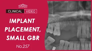 Implant placement and small GBR on healed ridge area - [Dr. Jeon Inseong]