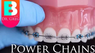 [BRACES EXPLAINED] Power Chains