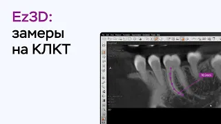 Возможности программы Ez3D: замеры на КЛКТ