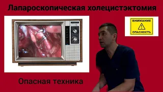 Лапароскопическая холецистэктомия. Опасная техника.