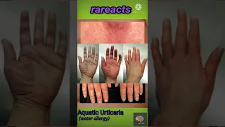 Aquatic Urticaria | water allergy| #shorts #rareacts #urticaria #allergy #aquaticurticaria