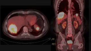 CT of Lymphoma Involving the Liver