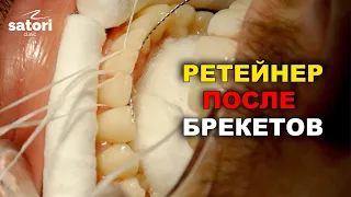 Ретейнер после снятия брекетов