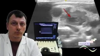 Pediatric soft tissues ultrasound - Purulent / Suppurative lymphadenitis