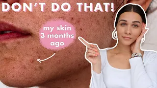skincare mistakes that make your ACNE WORSE!